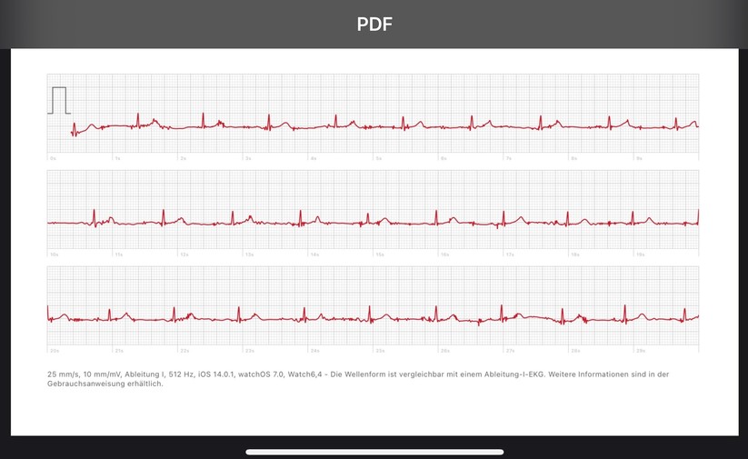 Den Verlauf des Elektrokardiogramms kann man sich als PDF herunterladen.